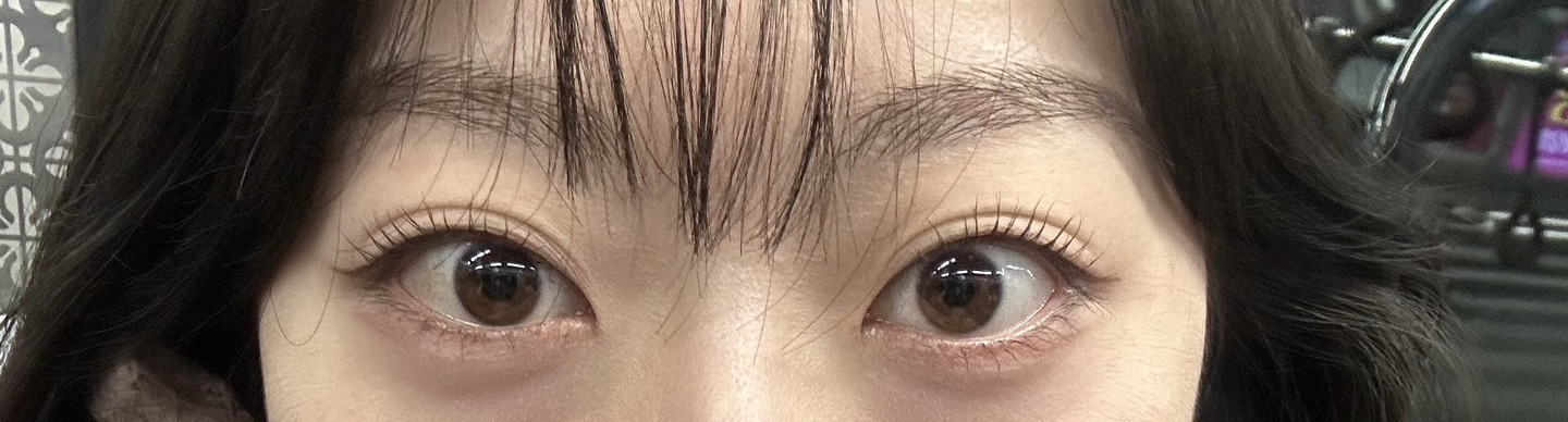 의사에게 물어보세요: 원래 큰 눈이고 돌... | 강남언니 - 1등 성형수술&피부시술 정보앱