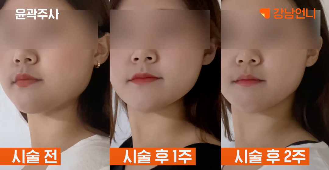 턱살 다이어트 전후 공개! 초 단기간 턱살빼는법 공유 | 강남언니