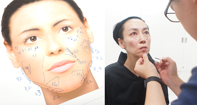 《手術室で注入部位のデザイン》カウンセリング時のメモを参考に、顔全体のバランスを見ながら注入部位のデザイン(マーキング)を行っていきます。ご予算の都合でヒアルロン酸の本数を減らした場合もご相談下さい。