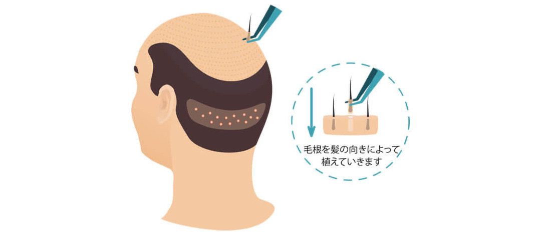 メガセッション 大量植毛 でfutは一度に1 800株まで可能だがfueは500株を超えるとドナーロス率が一気に上がる