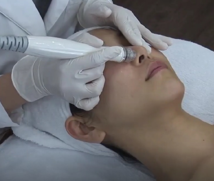 ハイドラジェントル(全顔):特殊な形状のチップによるトルネード水流で薬剤を塗布すると同時に、余分な角質や皮脂汚れを吸引します。水流を用いるため肌への負担が抑えられております。