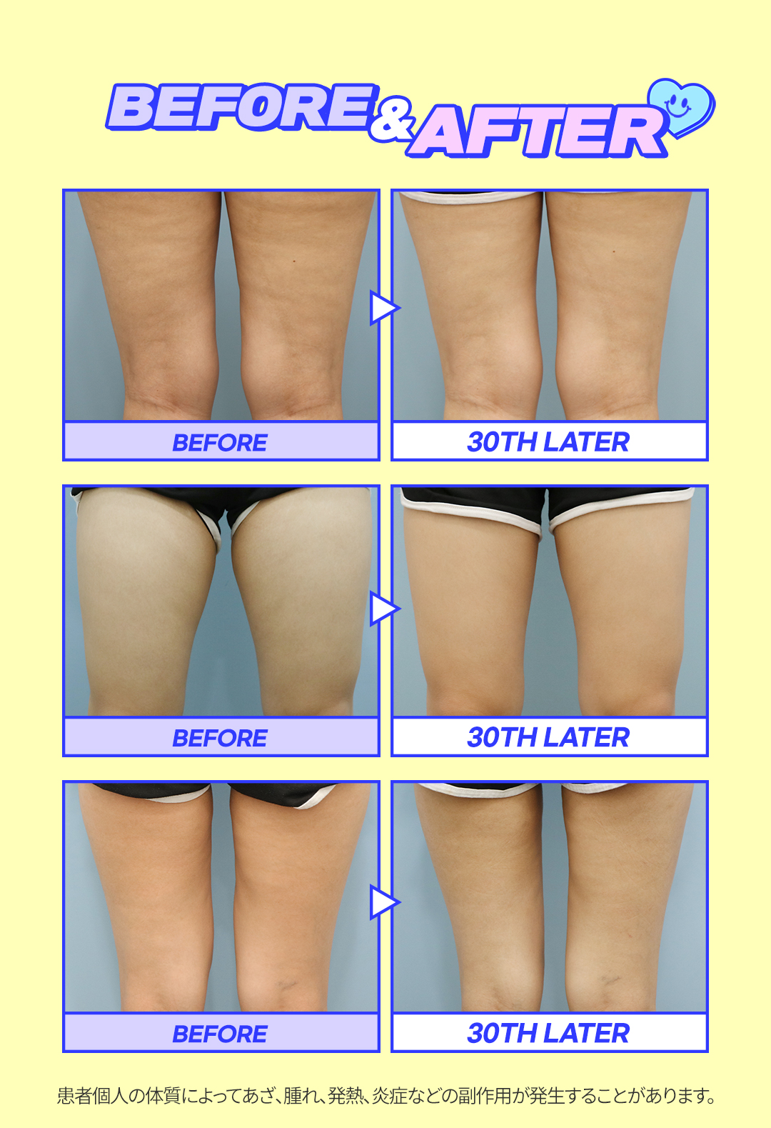 細い太ももでスリムに