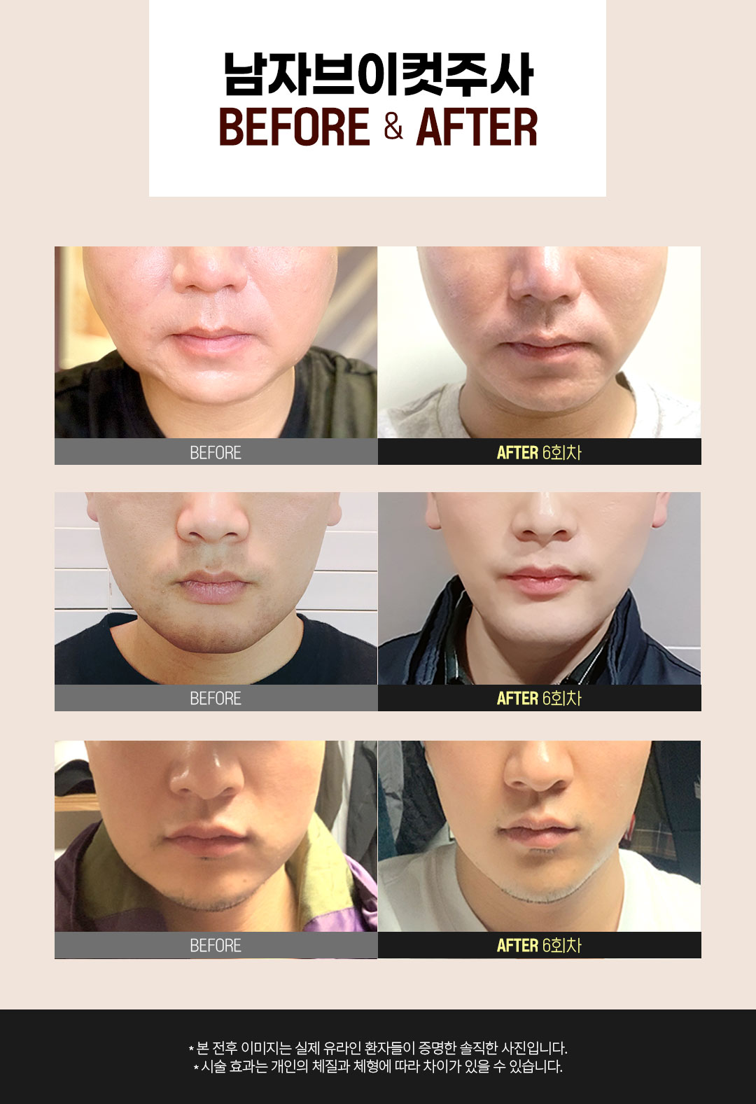 강남 브이씬 윤곽주사 전후 턱보톡스 2