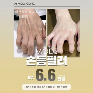 손등주름, 손등볼륨 UP, 모즈만의 이물감없는 손등필러