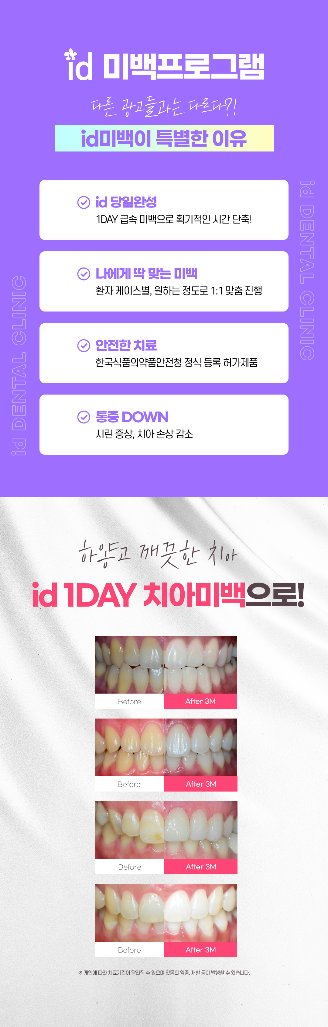 하루만에 보는 치아미백 효과 누런치아 케어