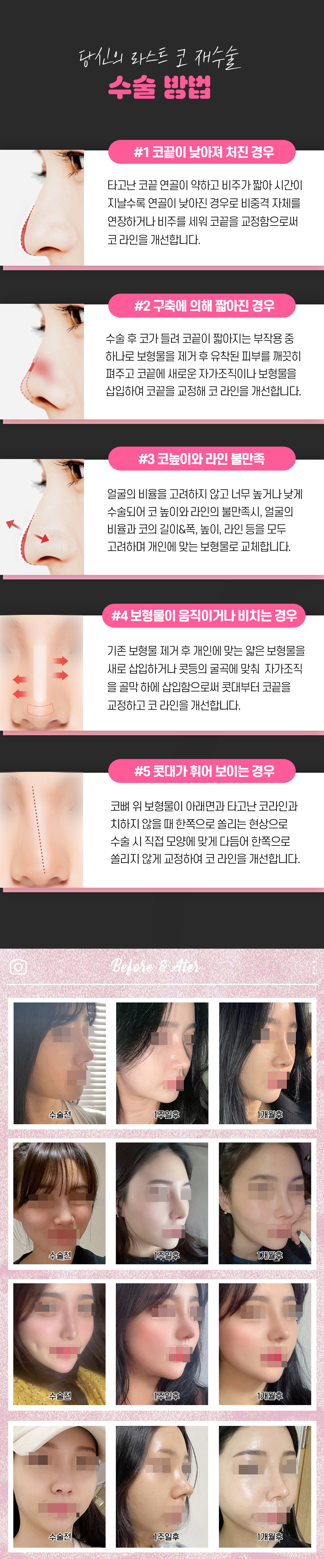라인재교정, 구축코, 염증코, 코재수술