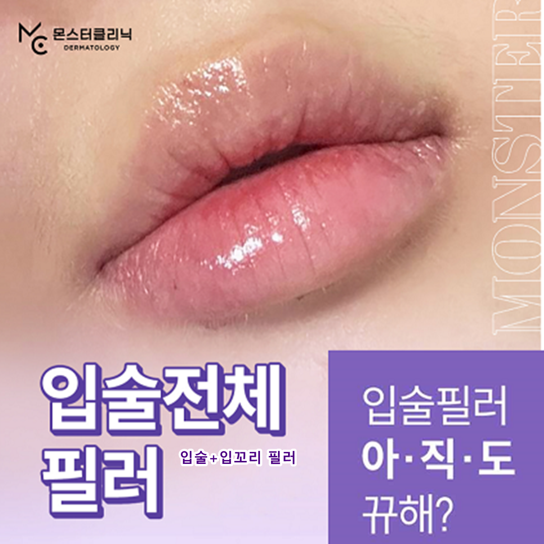 입술 입꼬리 필러 쀼X by 몬스터의원 | 강남언니 - 1등 성형수술&피부시술 정보앱