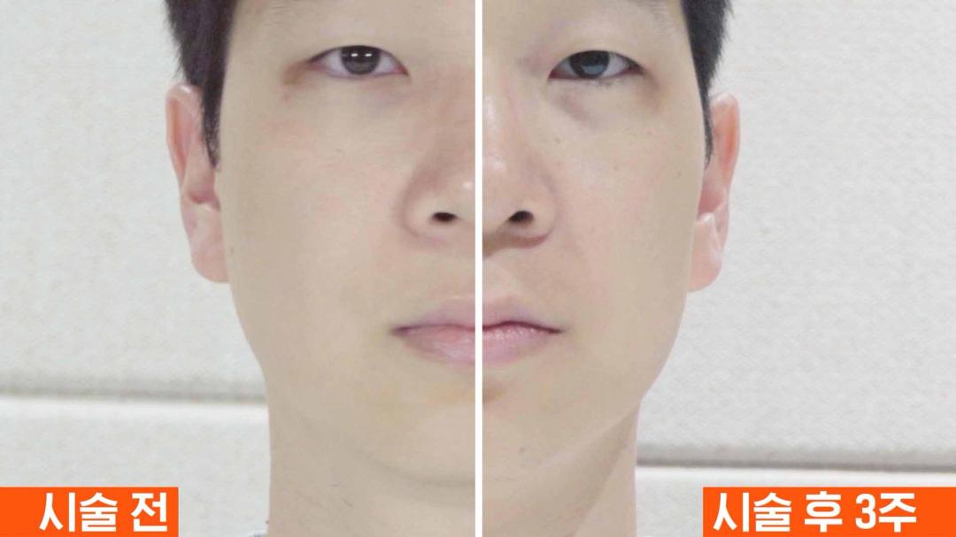 인모드 직후 전후 사진.jpg