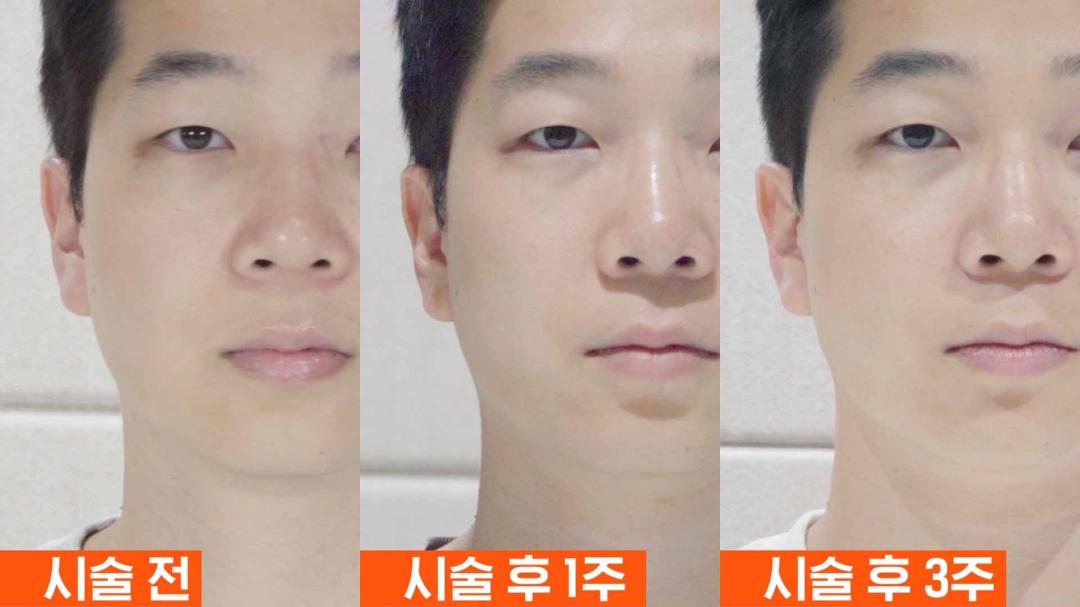 인모드 전후 모습 정면.jpg