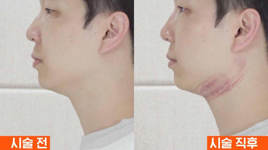 인모드 멍 부작용.jpg