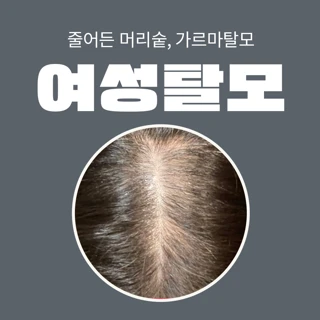 여성 탈모 치료