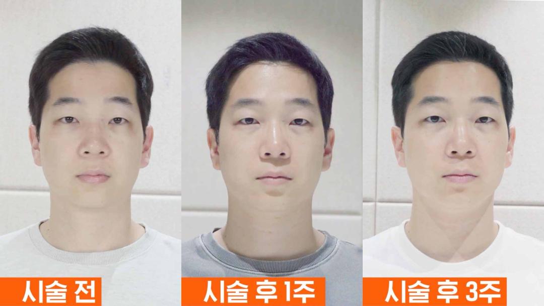 06_인모드 슈링크 동시에 받은 후기 사진.jpg