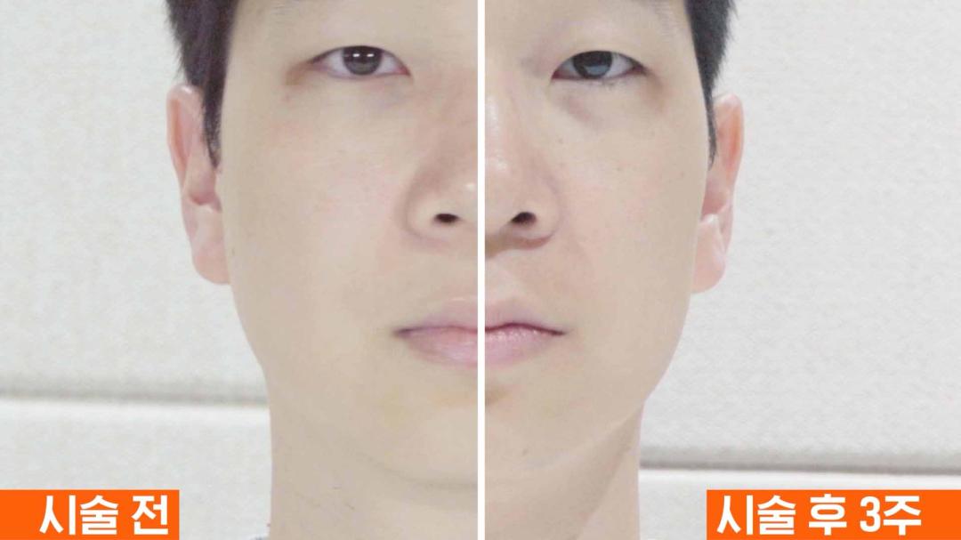 07_인모드 슈링크 동시에 받은 직후 전후 차이.jpg