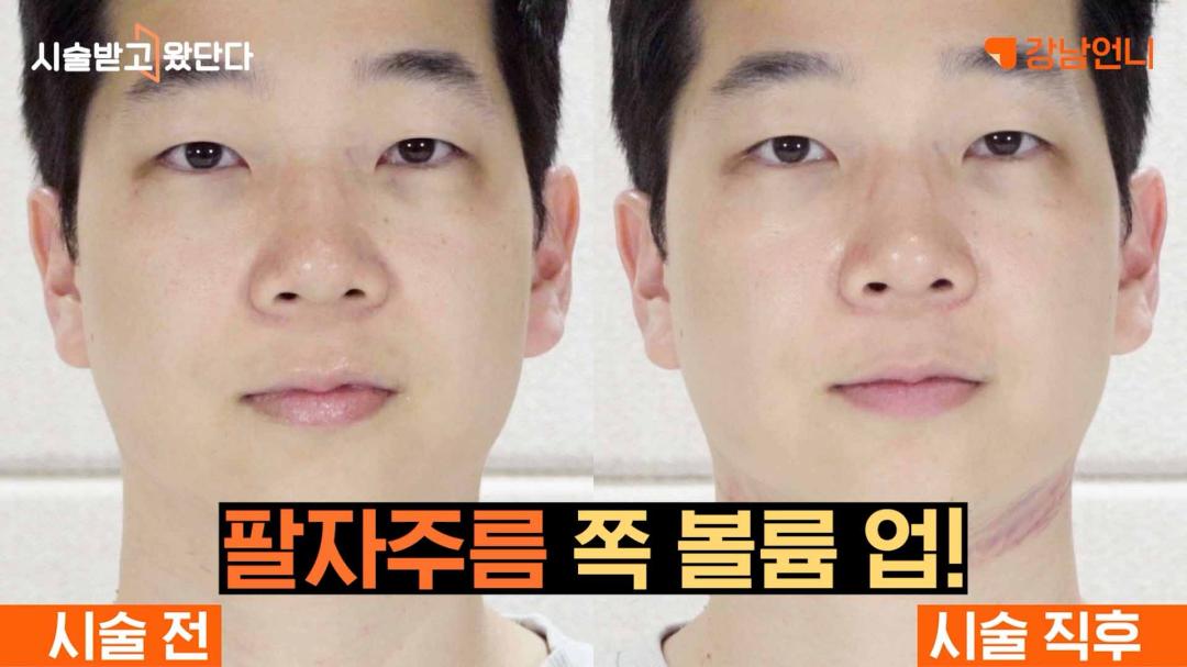 08_인모드 슈링크 같이 받은 직후모습 전후 차이.jpg