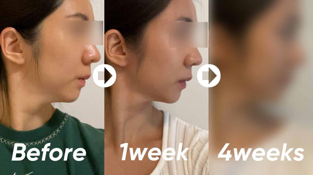 00_인모드 후기 썸네일.jpg