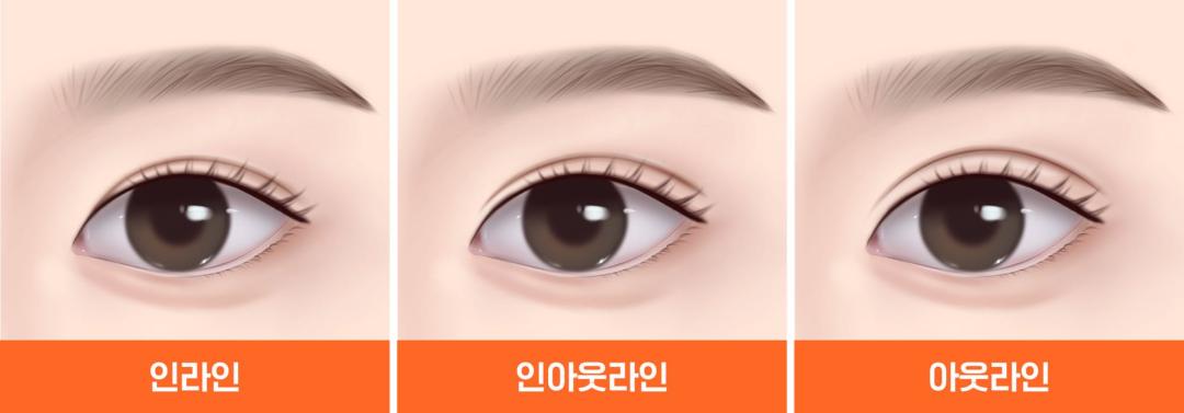 01_쌍꺼풀 라인 종류.jpg