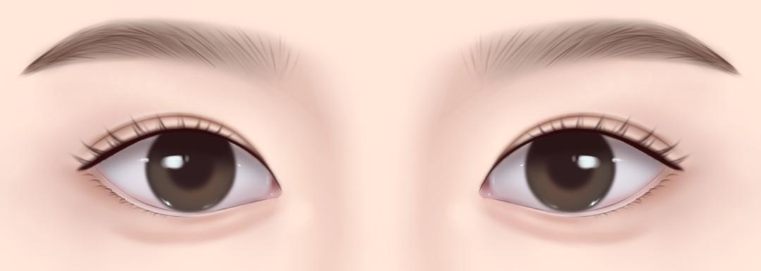 04_인라인 쌍꺼풀 종류 특징.jpeg