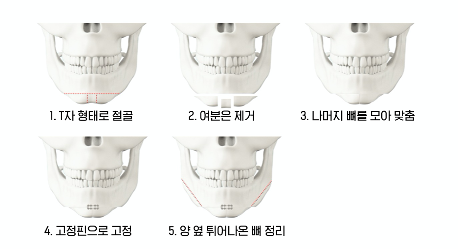 안면윤곽3종 -턱끝, 사각턱, 광대축소- 다 알려드려요! | 강남언니 - 1등 성형수술&피부시술 정보앱