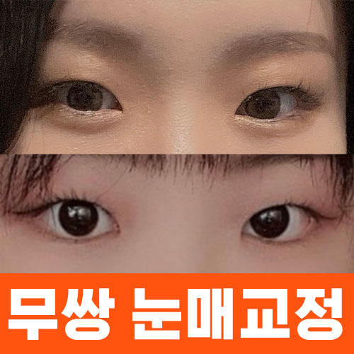 무쌍 눈매교정 썸네일