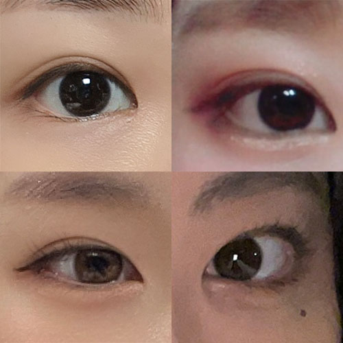 쌍꺼풀 종류 썸네일.jpg