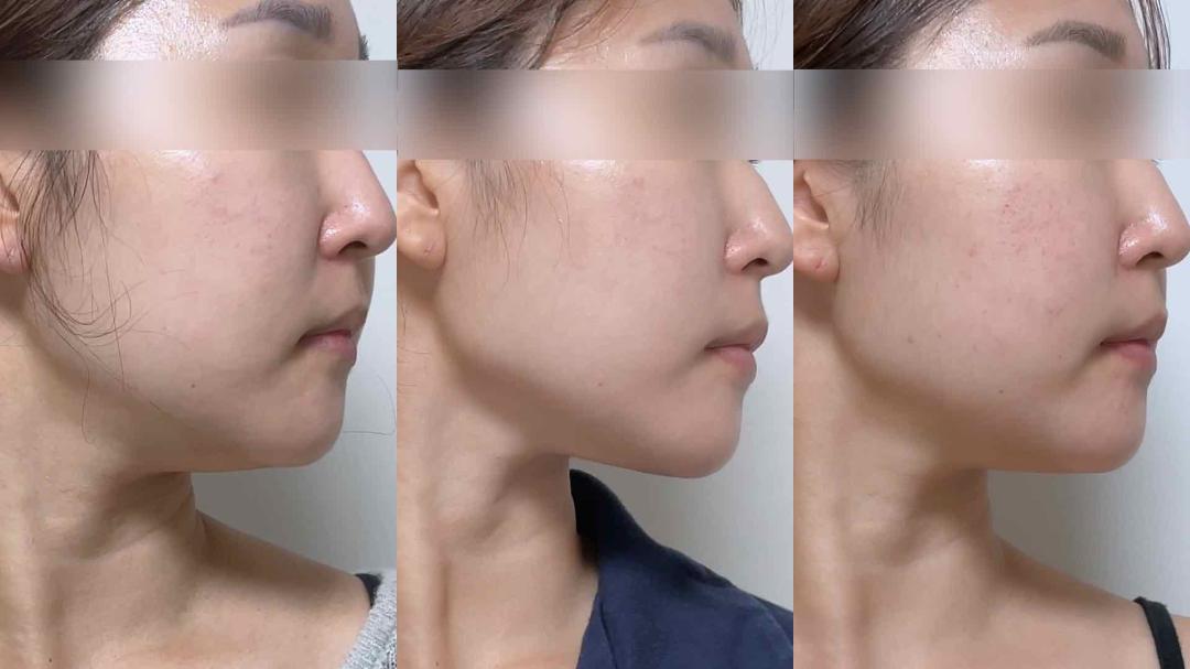 슈링크 전후차이 1.jpg