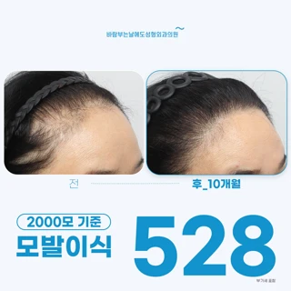 바람부는날에도_모발이식