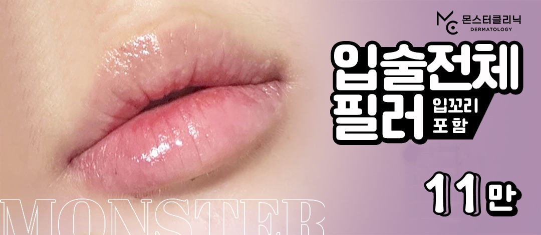 입술 입꼬리 필러 쀼X by 몬스터의원 | 강남언니 - 1등 성형수술&피부시술 정보앱