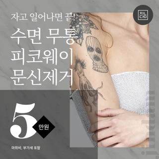 진담 수면 무통 문신제거, 피코웨이