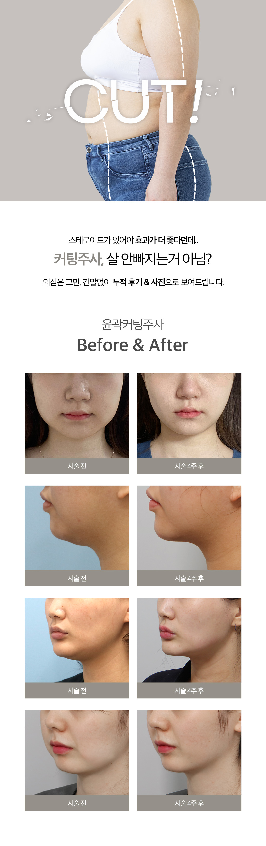 부작용 확률이 높은 스테로이드 성분을 제외한
천연지방분해+대사촉진+셀룰라이트분해 성분이 조합으로 강력 지방분해
기존 제이필스테디 후아유주사를 업그레이드한 강력지방커팅주사
- NO 스테로이드, PPC 성분으로 안전함 증명
- 후기가 증명하는 강력한 지방분해력
- 복부, 팔뚝, 허벅지 등 고민부위별 시술 가능