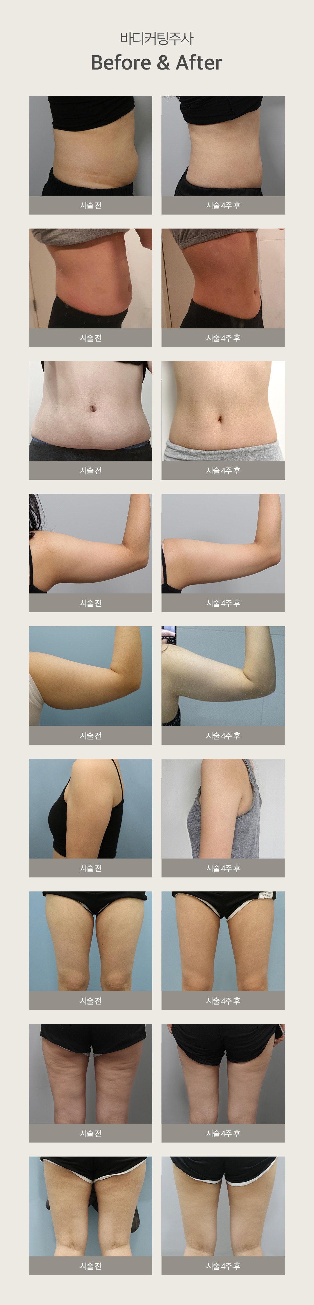 부작용 확률이 높은 스테로이드 성분을 제외한
천연지방분해+대사촉진+셀룰라이트분해 성분이 조합으로 강력 지방분해
기존 제이필스테디 후아유주사를 업그레이드한 강력지방커팅주사
- NO 스테로이드, PPC 성분으로 안전함 증명
- 후기가 증명하는 강력한 지방분해력
- 복부, 팔뚝, 허벅지 등 고민부위별 시술 가능