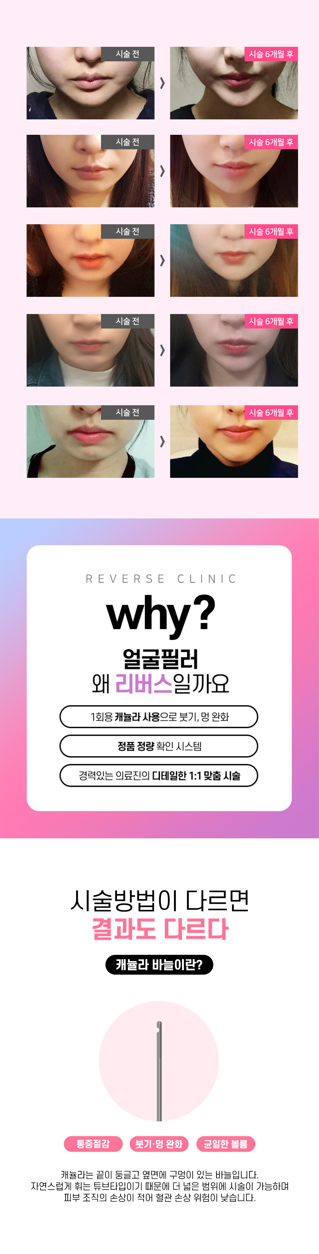 무턱필러와 자갈턱보톡스를 동시에 리버스 무턱필러