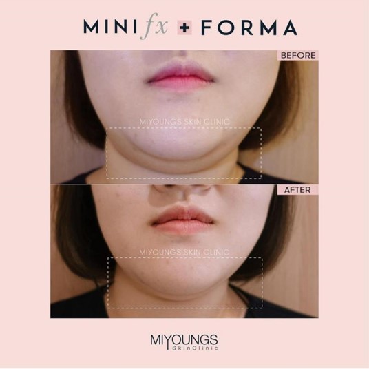 インモードリフトとは、インモード社が作っている機械のうち、低侵襲型のRF機器である「フォーマ(Forma)」と「ミニFx」を一緒に使用した小顔・リフトアップ施術の事が「インモード」と称されています。「フォーマ」「ミニFx」の両方を日本人に合わせた方法で行う施術で、効果的に脂肪を破壊しながら皮膚を引き締めるため、小顔・リフトアップ効果が期待できます。

インモード社の臨床担当者と日本の美容外科医・美容皮膚科医が協力し、 症例を重ね、アジア人に対して最も効果的に結果が出せるように研究開発されたプロトコルが「インモードリフト」です。照射の順番や照射パワー、皮膚に与える総熱量、照射方法がアジア人の肌質に最適な基準が設定され、トラブル時の対応方法なども決められています。

-ミニFXについて
組織を吸引しながらRF波を照射することで、深部にまで熱エネルギーを到達させることの可能なハンドピースです。
2000 ボルトのナノ秒RFパルス波を照射することが可能で、そのパルス波が脂肪の破壊を誘発するため、効率的に皮下脂肪を減少させることができます。また、バイポーラー型RFエネルギーも照射されるため、スキンタイトニング効果も期待できます。安全に永続的に脂肪細胞を破壊し、ダウンタイムはほぼなく、痛みも最小限に抑えられます。

-フォーマについて
真皮層に高周波を照射し、肌を引き締めることに特化したハンドピースです。38~43℃の間で設定可能な温度センサー(安全装置)が搭載されているため、熱傷(やけど)のリスクを最小限にしながら、最大の引き締め効果が期待できます。人の肌は40℃を超えるとコラーゲン・エラスチンなどのハリや弾力に関係している物質の生成が促進されます。インモードリフトでは42～43℃に設定するように決められています。コラーゲン再構築によって長期的に持続する引き締め効果があります。

