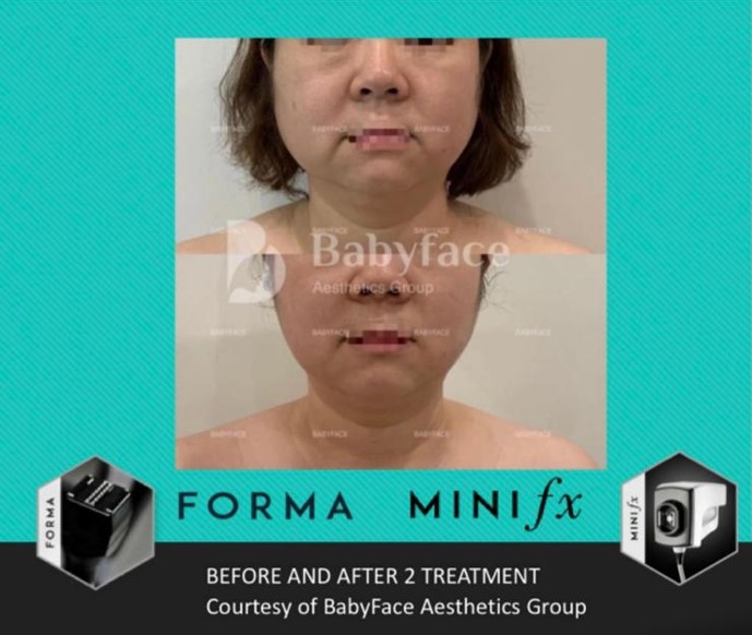 インモードリフトとは、インモード社が作っている機械のうち、低侵襲型のRF機器である「フォーマ(Forma)」と「ミニFx」を一緒に使用した小顔・リフトアップ施術の事が「インモード」と称されています。「フォーマ」「ミニFx」の両方を日本人に合わせた方法で行う施術で、効果的に脂肪を破壊しながら皮膚を引き締めるため、小顔・リフトアップ効果が期待できます。
インモード社の臨床担当者と日本の美容外科医・美容皮膚科医が協力し、 症例を重ね、アジア人に対して最も効果的に結果が出せるように研究開発されたプロトコルが「インモードリフト」です。照射の順番や照射パワー、皮膚に与える総熱量、照射方法がアジア人の肌質に最適な基準が設定され、トラブル時の対応方法なども決められています。
-ミニFXについて
組織を吸引しながらRF波を照射することで、深部にまで熱エネルギーを到達させることの可能なハンドピースです。
2000 ボルトのナノ秒RFパルス波を照射することが可能で、そのパルス波が脂肪の破壊を誘発するため、効率的に皮下脂肪を減少させることができます。また、バイポーラー型RFエネルギーも照射されるため、スキンタイトニング効果も期待できます。安全に永続的に脂肪細胞を破壊し、ダウンタイムはほぼなく、痛みも最小限に抑えられます。
-フォーマについて
真皮層に高周波を照射し、肌を引き締めることに特化したハンドピースです。38~43℃の間で設定可能な温度センサー(安全装置)が搭載されているため、熱傷(やけど)のリスクを最小限にしながら、最大の引き締め効果が期待できます。人の肌は40℃を超えるとコラーゲン・エラスチンなどのハリや弾力に関係している物質の生成が促進されます。インモードリフトでは42~43℃に設定するように決められています。コラーゲン再構築によって長期的に持続する引き締め効果があります。