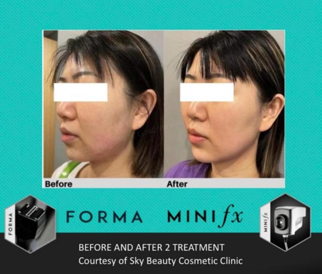 インモードリフトとは、インモード社が作っている機械のうち、低侵襲型のRF機器である「フォーマ(Forma)」と「ミニFx」を一緒に使用した小顔・リフトアップ施術の事が「インモード」と称されています。「フォーマ」「ミニFx」の両方を日本人に合わせた方法で行う施術で、効果的に脂肪を破壊しながら皮膚を引き締めるため、小顔・リフトアップ効果が期待できます。
インモード社の臨床担当者と日本の美容外科医・美容皮膚科医が協力し、 症例を重ね、アジア人に対して最も効果的に結果が出せるように研究開発されたプロトコルが「インモードリフト」です。照射の順番や照射パワー、皮膚に与える総熱量、照射方法がアジア人の肌質に最適な基準が設定され、トラブル時の対応方法なども決められています。
-ミニFXについて
組織を吸引しながらRF波を照射することで、深部にまで熱エネルギーを到達させることの可能なハンドピースです。
2000 ボルトのナノ秒RFパルス波を照射することが可能で、そのパルス波が脂肪の破壊を誘発するため、効率的に皮下脂肪を減少させることができます。また、バイポーラー型RFエネルギーも照射されるため、スキンタイトニング効果も期待できます。安全に永続的に脂肪細胞を破壊し、ダウンタイムはほぼなく、痛みも最小限に抑えられます。
-フォーマについて
真皮層に高周波を照射し、肌を引き締めることに特化したハンドピースです。38~43℃の間で設定可能な温度センサー(安全装置)が搭載されているため、熱傷(やけど)のリスクを最小限にしながら、最大の引き締め効果が期待できます。人の肌は40℃を超えるとコラーゲン・エラスチンなどのハリや弾力に関係している物質の生成が促進されます。インモードリフトでは42~43℃に設定するように決められています。コラーゲン再構築によって長期的に持続する引き締め効果があります。