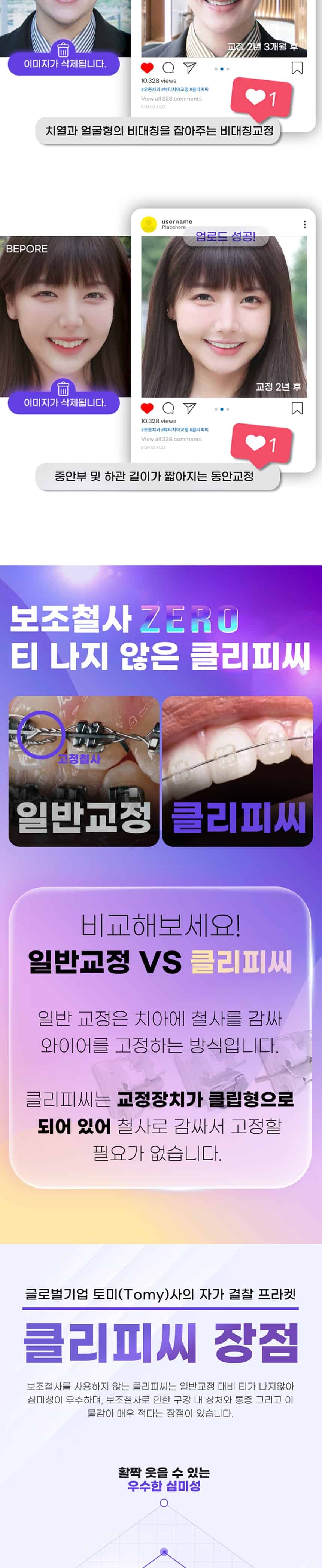 클리피씨 전체교정 치아교정