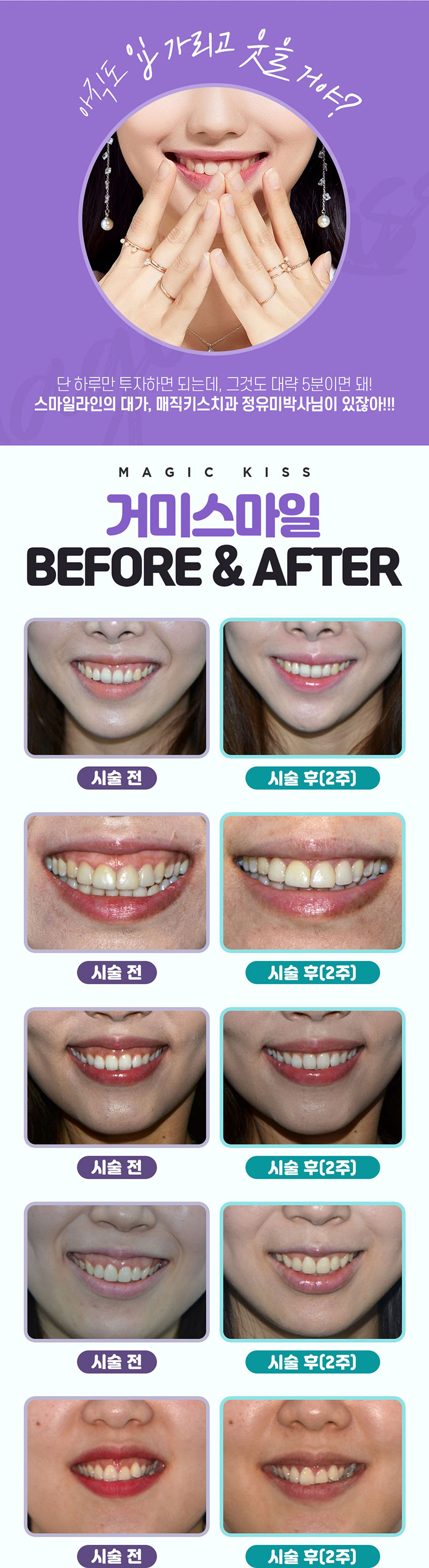 정유미박사님과 함께 하는 시술_ 잇몸이 많이 보이는 거미스마일 & 삐뚤거리는 비대칭 스마일 & 입꼬리 개선을 위한 보톡스 모두 모여-