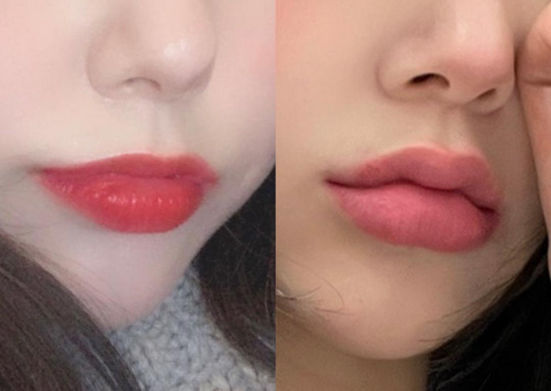 입술필러로 이미지 변신한 후기 - 가격, 전후 사진, 부작용까지 | 강남언니 - 1등 성형수술&피부시술 정보앱
