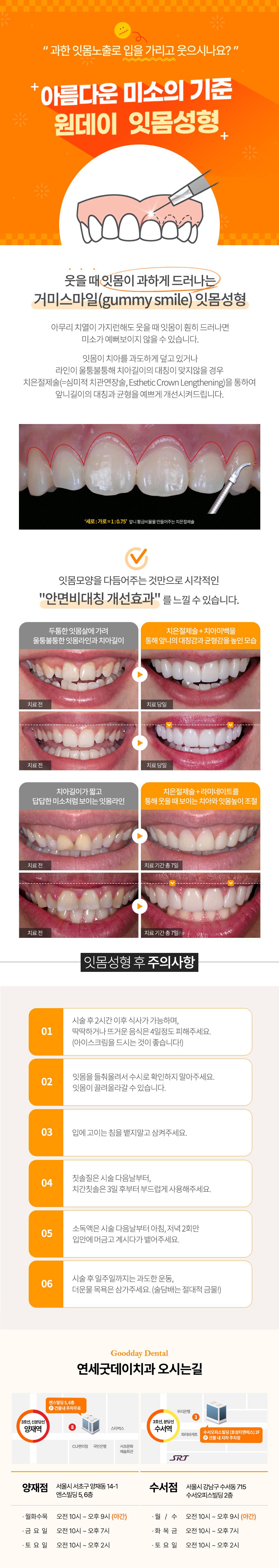 치아가 잇몸에 가려져있는 잇몸비대증, 원데이 잇몸성형으로 해결