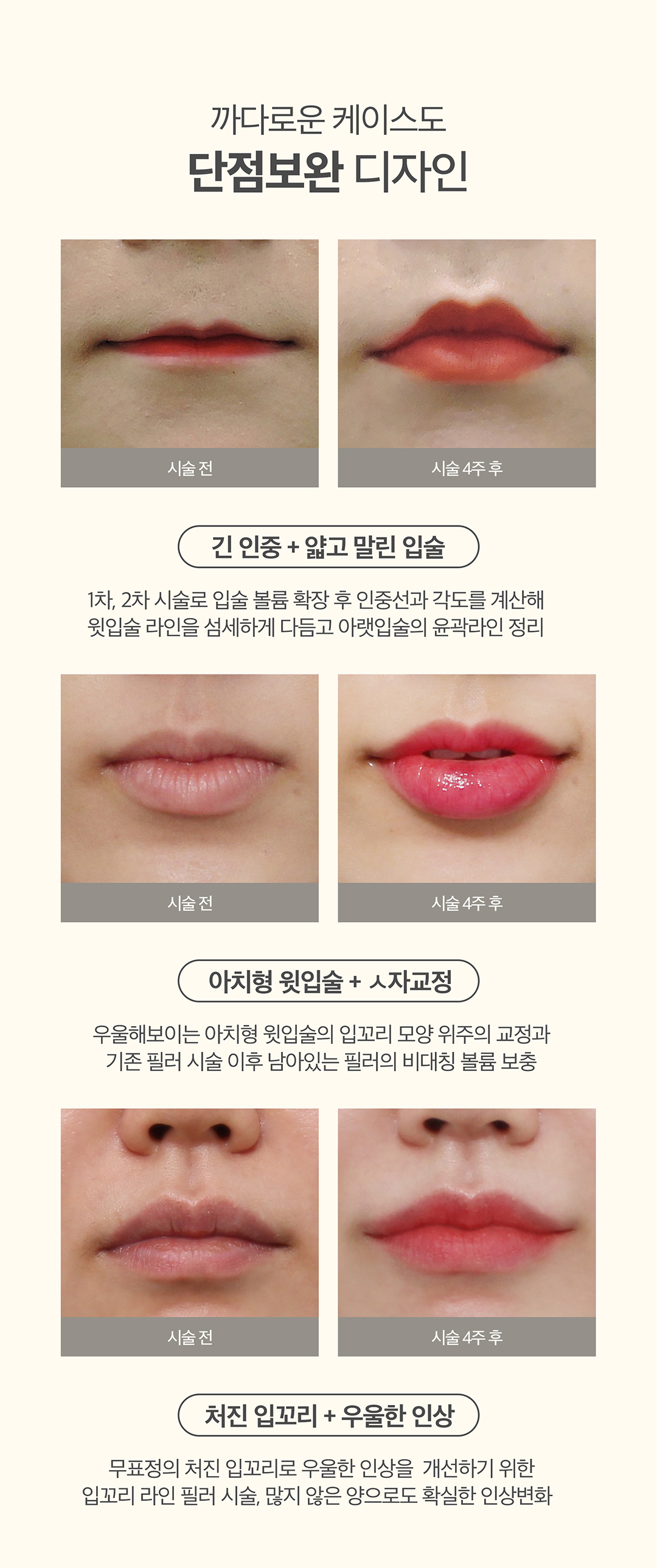 입술필러엔 입꼬리필러&입꼬리보톡스로 사랑스러운 매력입매 만드는 시술
-입술볼륨크기, 입꼬리 처짐 정도, 얼굴 폭 밸런스 등을 파악하여 진행
-긴인중, 아치형윗입술, 우울한 인상 등 까다로운 케이스도 보완 가능
-1차, 2차 시술로 입술 볼륨 확장 후 인중선과 각도 계산