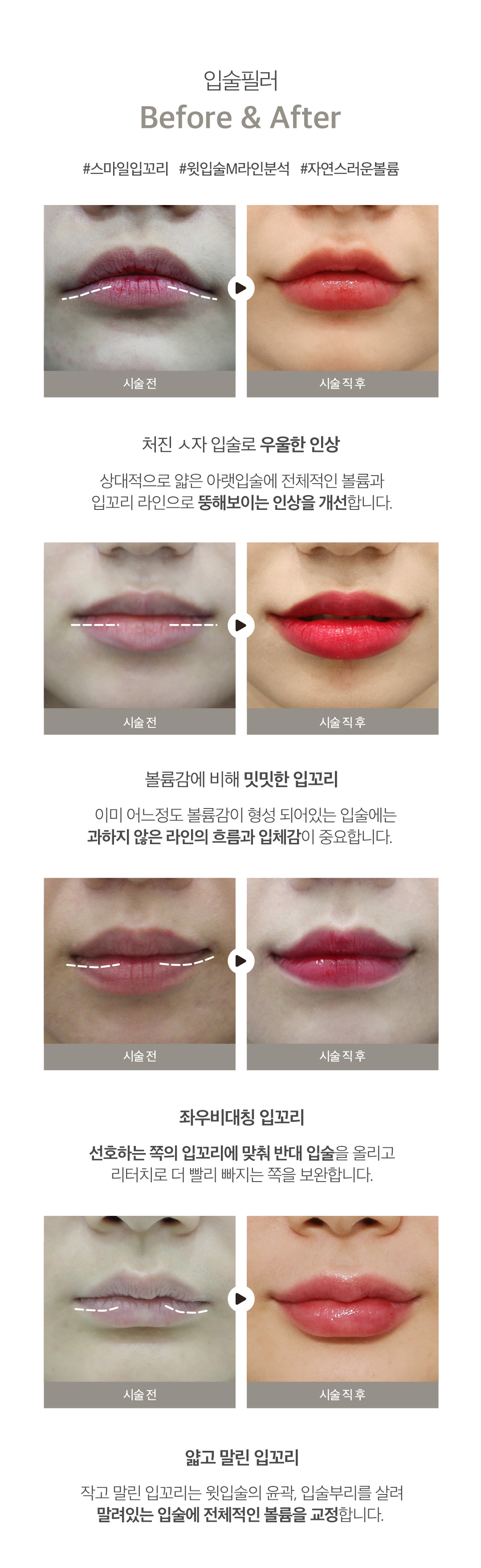입술필러엔 입꼬리필러&입꼬리보톡스로 사랑스러운 매력입매 만드는 시술
-입술볼륨크기, 입꼬리 처짐 정도, 얼굴 폭 밸런스 등을 파악하여 진행
-긴인중, 아치형윗입술, 우울한 인상 등 까다로운 케이스도 보완 가능
-1차, 2차 시술로 입술 볼륨 확장 후 인중선과 각도 계산