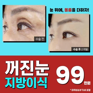 고유 꺼진눈지방이식
