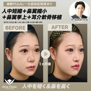 【局所麻酔込み】人中短縮＋鼻翼縮小＋鼻翼挙上＋耳介軟骨移植＋Cカール形成｜人中を短く＆鼻を高く
