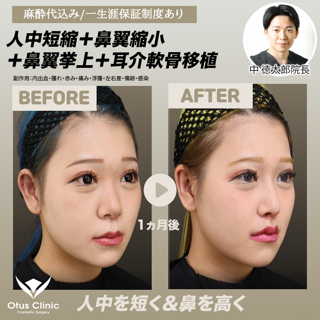 鼻翼 