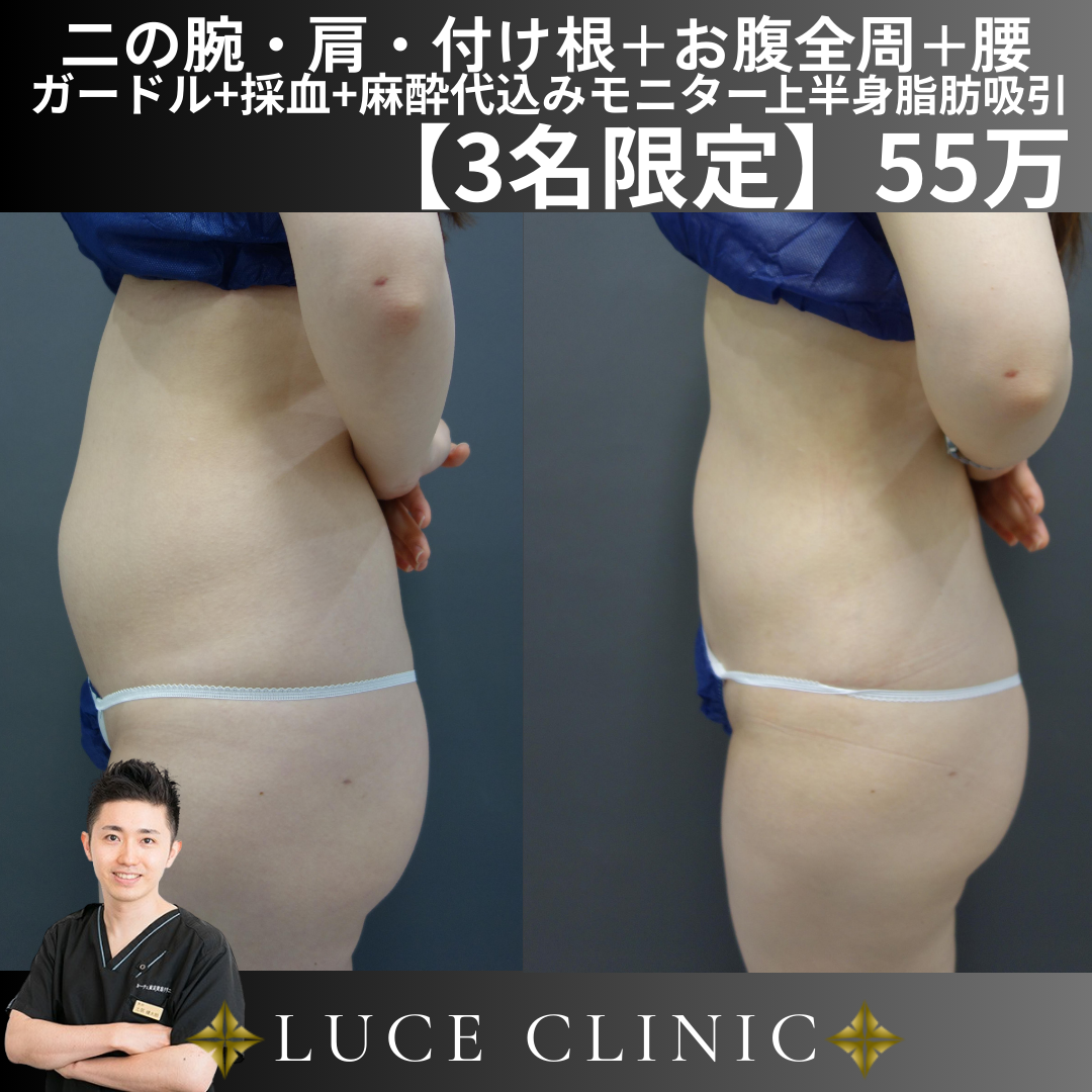 アミュレット 脂肪吸引 圧迫 ガードル Lサイズ 湘南美容外科