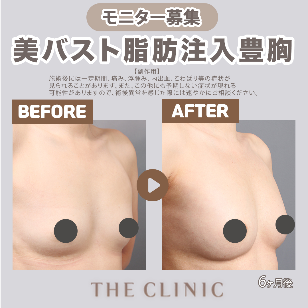豊 胸 モニター