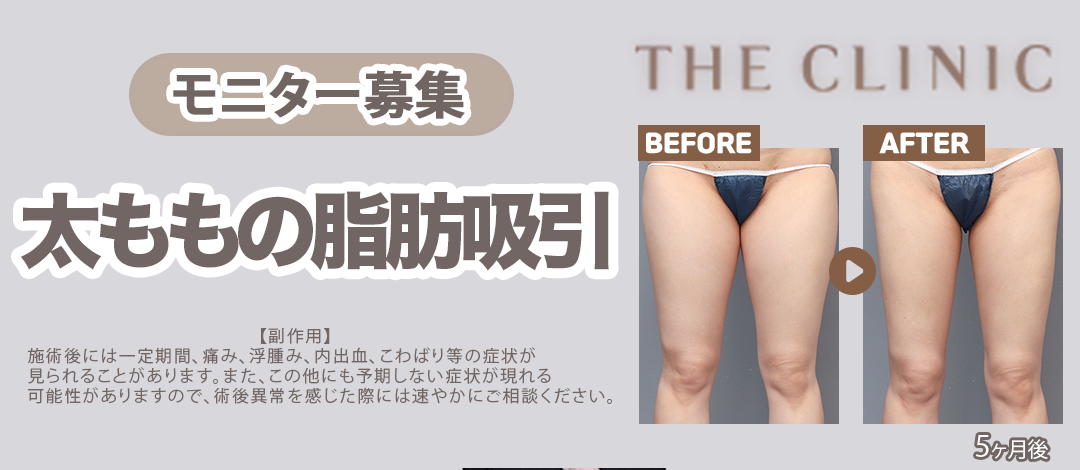 太ももの脂肪吸引モニター | THE CLINIC（ザクリニック）広島院
