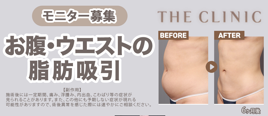 脂肪吸引実績1,900件】お腹・ウエストの360°脂肪吸引｜ベイザー認定医