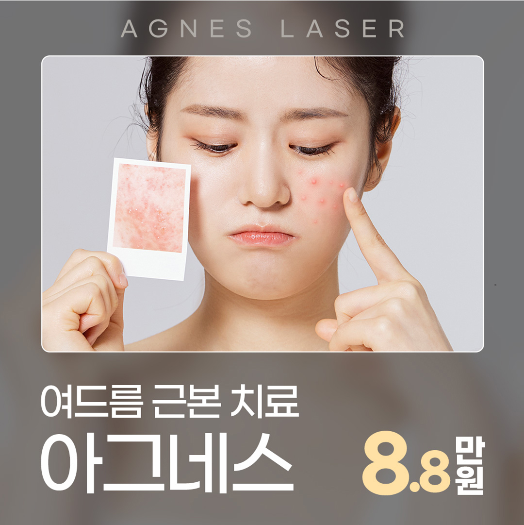 피지선 파괴 레이저 아그네스로 여드름 재발은 STOP
- 피부 표피는 보호하면서 피지선만 선택적으로 파괴하는 치료법
- 파괴된 피지선으로 인해 여드름 발생 가능성 DOWN
- 1~3회 시술로도 만족스러운 효과 얻을 수 있음
- KFDA 및 유럽 CE의 인증을 획득한 장비