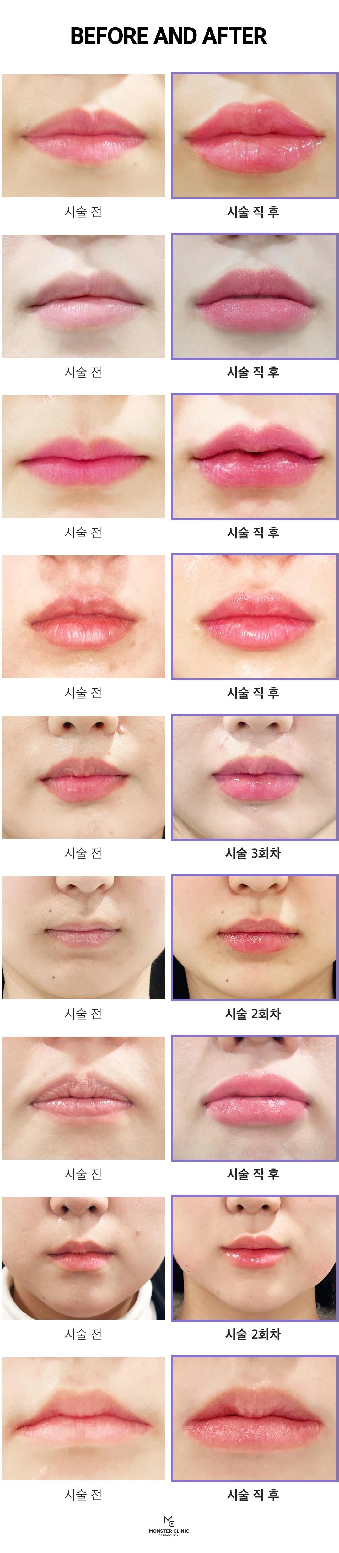 입술 입꼬리 전체필러 뀨x by 몬스터의원 | 강남언니 - 1등 성형수술&피부시술 정보앱