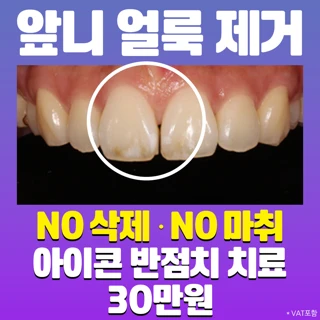 치아 얼룩 깎지말고 아이콘 반점치 시술하세요